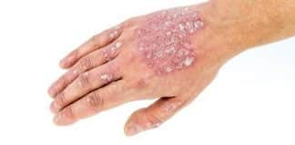 Link between autoimmune disorders and psychosis confirmed in new study