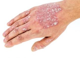 Link between autoimmune disorders and psychosis confirmed in new study
